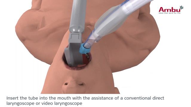 Intubation and final position of VivaSight-DL смотреть онлайн