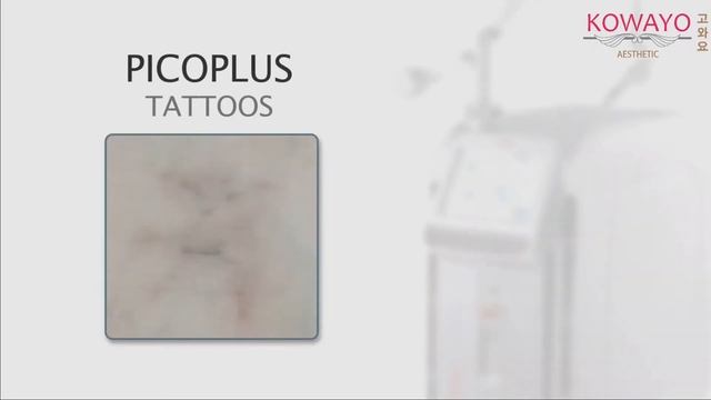 Pico Plus Laser in Kowayo смотреть онлайн