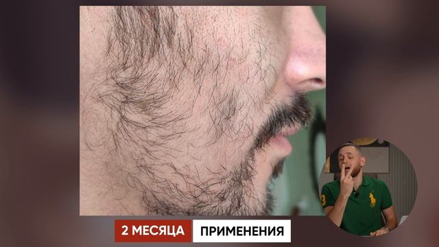 АЗИАТ ЗА 4 МЕСЯЦА ОТРАСТИЛ ШИКАРНУЮ БОРОДУ / Результаты mr.Volos смотреть онлайн