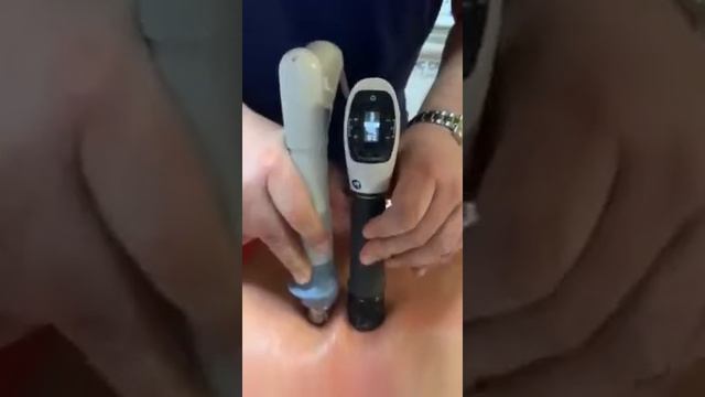 STORZ MEDICAL SHOCKWAVE THERAPY смотреть онлайн