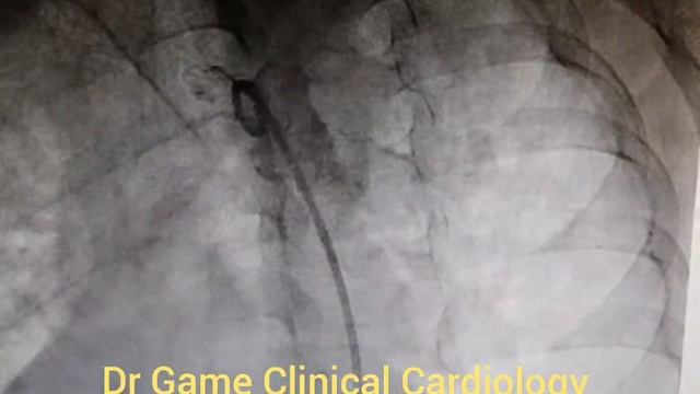 Coarctation of Aorta - Cath Clip смотреть онлайн