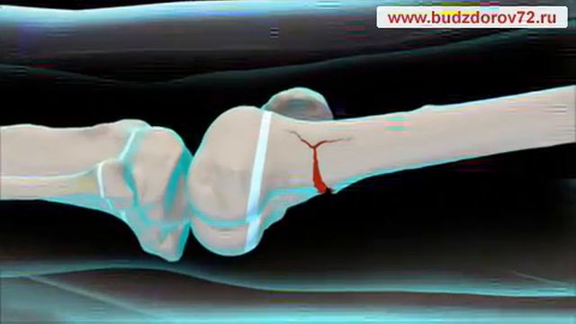 Medical Animation. Broken leg in children смотреть онлайн