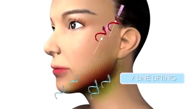Cinderella beauty clinic / Mongolia/ - PDO Cleopatra treatment смотреть онлайн