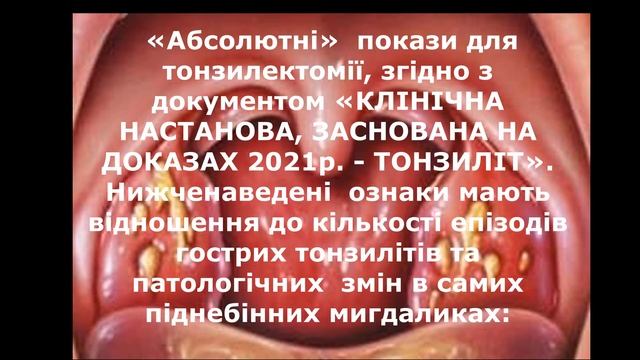 Ніколи не видаляйте піднебінні мигдалики (гланди), до перегляду цього відео!! смотреть онлайн
