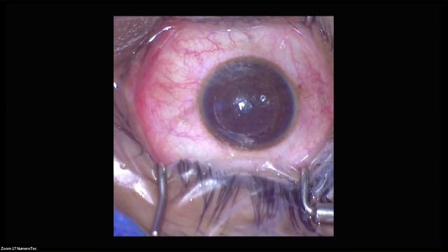 SMILE Pro Live procedure demonstration | Madras City Ophthalmic association meeting | Uma Eye Clini смотреть онлайн
