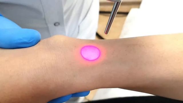 Epilare laser, zona mâinilor. Laser Alexandrite Cynosure Apogee Elite смотреть онлайн