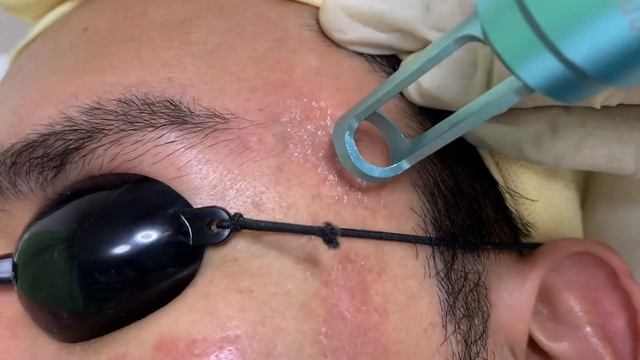 My First Session with Pico Laser Treatment смотреть онлайн