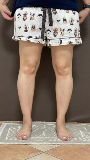 Варусная деформации ног + Ротация с обеих сторон. Пациентка- 1979 гр смотреть онлайн