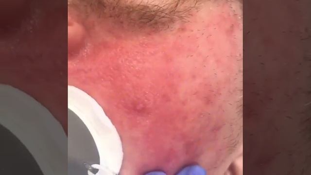 Розацеа ДО и сразу ПОСЛЕ обработки лазером смотреть онлайн