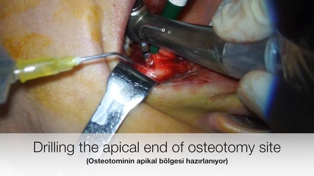 Implant placement using dental microscope смотреть онлайн