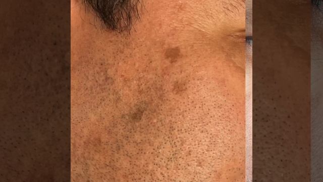 Tratamiento Láser Para Eliminar Manchas Faciales 👩⚕️👨⚕️ смотреть онлайн