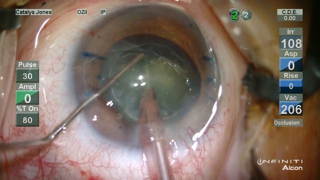 Catalys Femtosecond Phaco Surgery смотреть онлайн