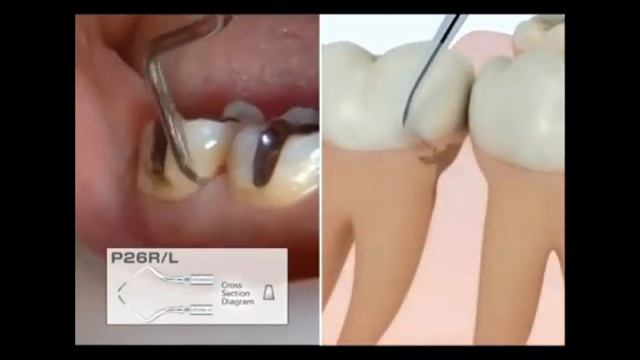 NSK Varios Scaler Tip P26 R/L(구치부 치은연하용)-1 смотреть онлайн