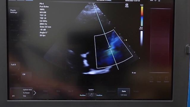 How to use Tissue Doppler in echocardiography - even if you don't have TDI software! смотреть онлайн