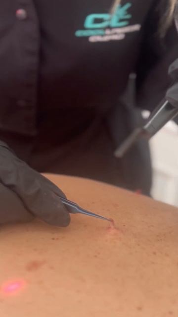 Лазерное удаление родинок #родинки смотреть онлайн