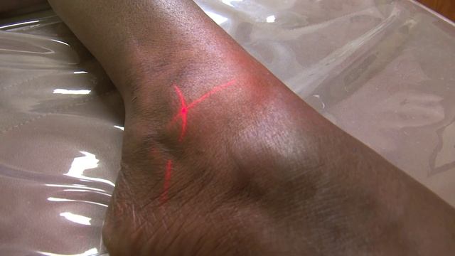 MLS Laser Patient Education Video смотреть онлайн