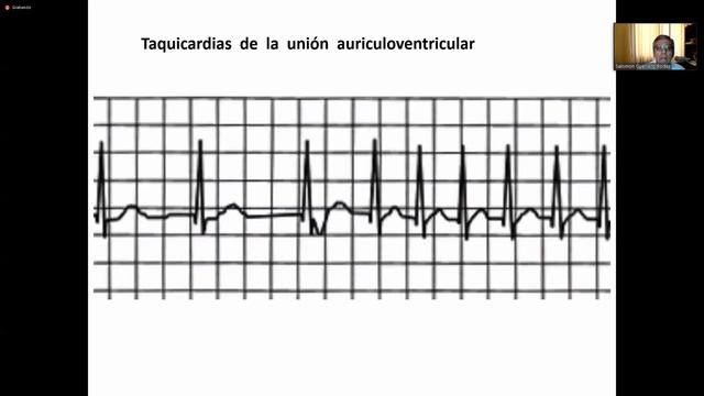 MEDICINA II - TAQUIARRITMIAS Y BRADIARRITMIAS смотреть онлайн