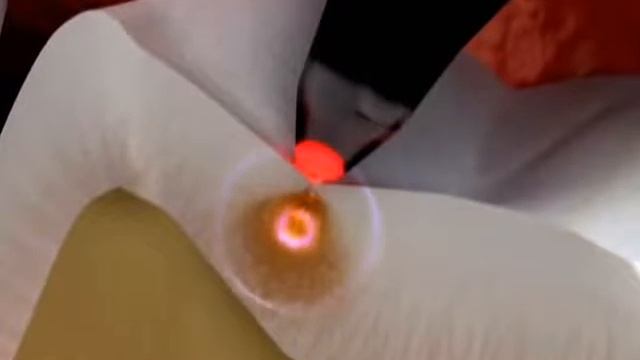 Diagnodent Laser Cavity Detection смотреть онлайн
