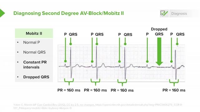 1.10 Bradyarrhythmias- Three Degrees of AV-Block смотреть онлайн