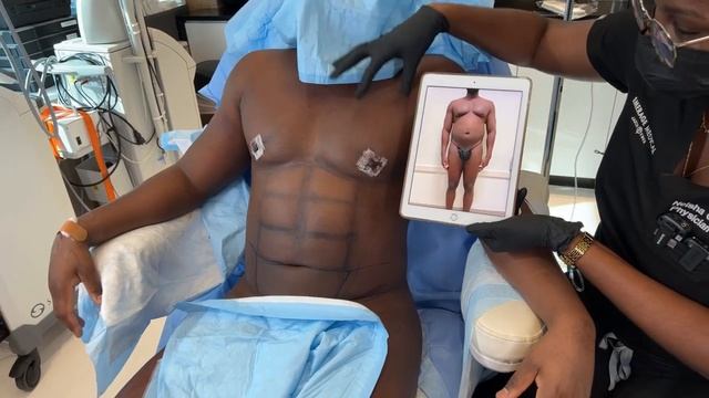 1 DAY AFTER LIPO SURGERY AND HAVE A RIPPED GLADIATOR SIX PACK | LYMPHATIC MASSAGE | Dr. Jason Emer смотреть онлайн