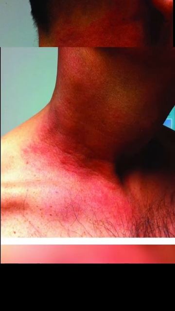 Radiotherapy Dermatitis or Burn I Symptoms of Dermatitis #shorts смотреть онлайн