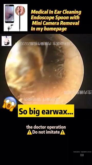 Best Ear Wax Removal & Extraction with Vacuum Remover 真空リムーバーによるにきびの除去と抽出 174 смотреть онлайн