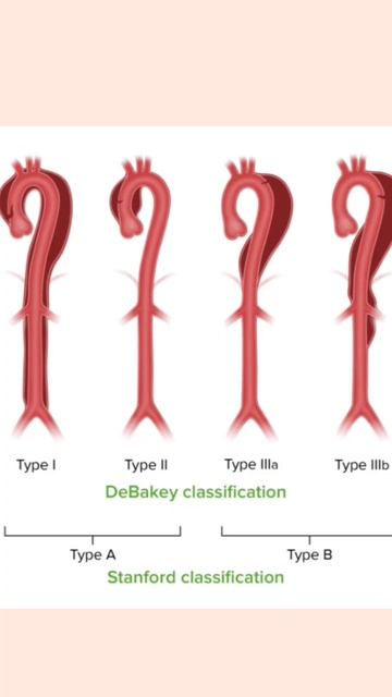Aortic dissection | Ultrasound | Dr Sudhanshu Tandon #ultrasound #shorts #youtubeshorts смотреть онлайн