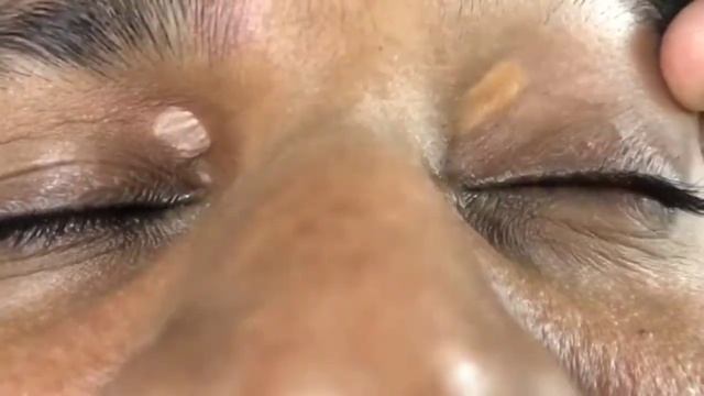 Xanthelasma : chemical touch @royaldermaskinclinic white spot over eye #skincare #9455090303 смотреть онлайн