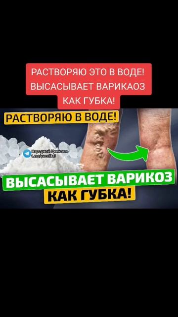ВЫСАСЫВАЕТ варикоз как губка #здоровье #народнаямедицина #зож #рецепт #медицина #здоров смотреть онлайн