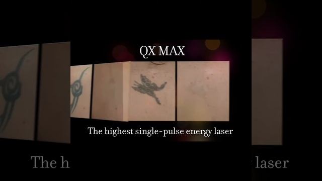 Fotona Laser Treatment смотреть онлайн