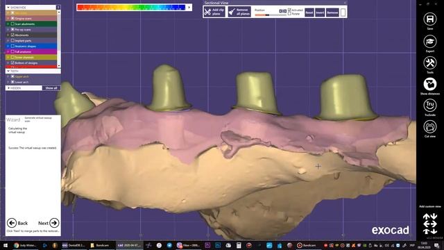Cerec 3D моделирование коронки смотреть онлайн