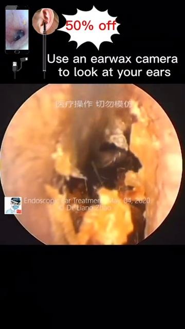 Best Ear Wax Removal & Extraction with Vacuum Remover 真空リムーバーによるにきびの除去と抽出 225 смотреть онлайн