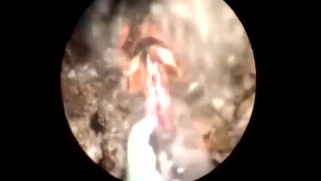 Diode laser for urology II presented by MANAV ELECTRNICS смотреть онлайн