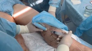 Проведение лазерного лечения варикоза в медицинском центре ВенЗдрав. Лечение 2х ног.