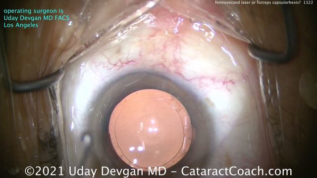 CataractCoach 1322: femtosecond laser or forceps capsulorhexis? Which is better? смотреть онлайн
