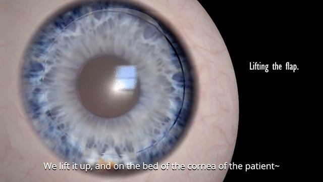What it's like to get FEMTO LASIK Eye surgery Percy Montgomery? смотреть онлайн