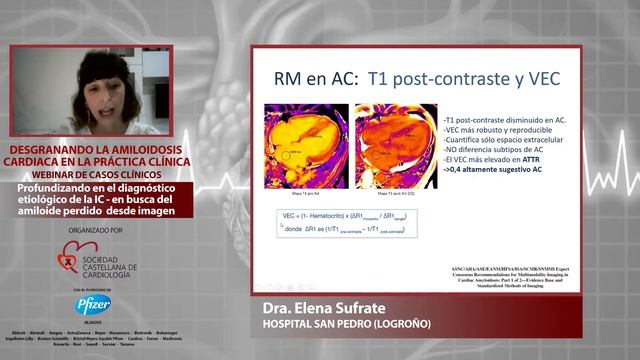 Desgranando la Amiloidosis Cardiaca en la Práctica Clínica - 17 Noviembre 2020 смотреть онлайн