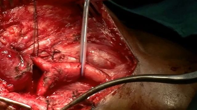 Carotid body tumor смотреть онлайн