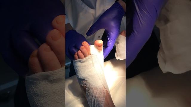 Вальгус (перевязка)