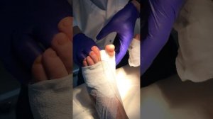 Вальгус (перевязка)