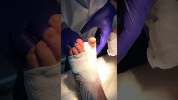 Вальгус (перевязка)