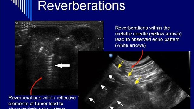 Physics of Ultrasound - Image Artifacts NEW Segment #3 смотреть онлайн