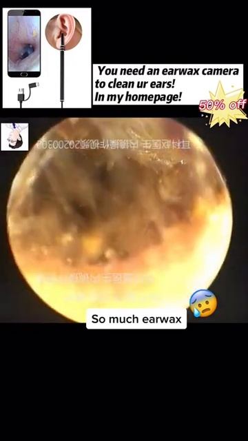 Best Ear Wax Removal & Extraction with Vacuum Remover 真空リムーバーによるにきびの除去と抽出 96 смотреть онлайн