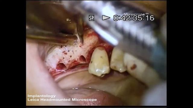 Leica HM500 User Video Dental - Implantology смотреть онлайн