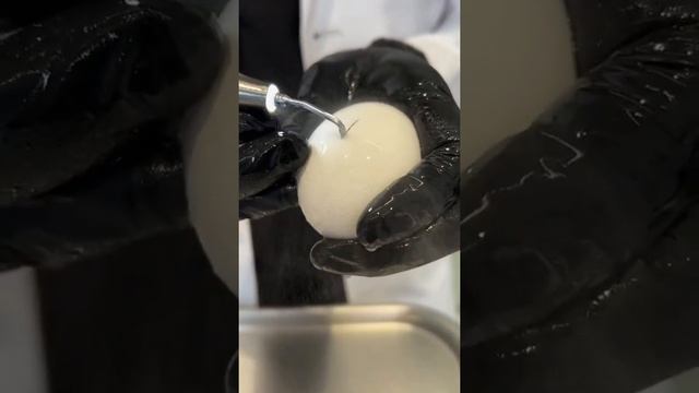 GENTLE AND PRESCISE RHINOPLASTIES WITH ULTRASONIC PIEZO | Dr. AKSHAY SANAN смотреть онлайн
