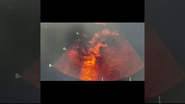 Cardiac Sarcoidosis.