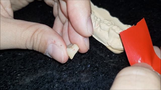 Checking proximal contacts on prosthesis using 12 micron Arti-fol from Bausch смотреть онлайн