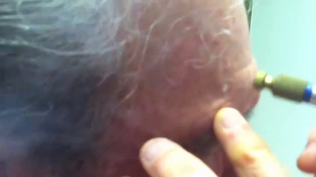 Actinic Keratosis смотреть онлайн