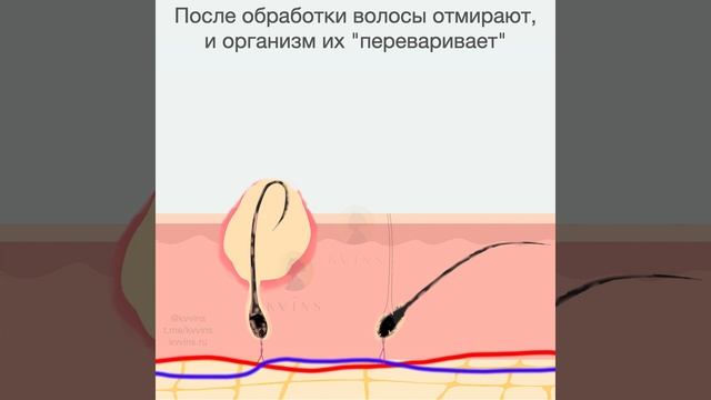 Квинс Вросшие волосы.