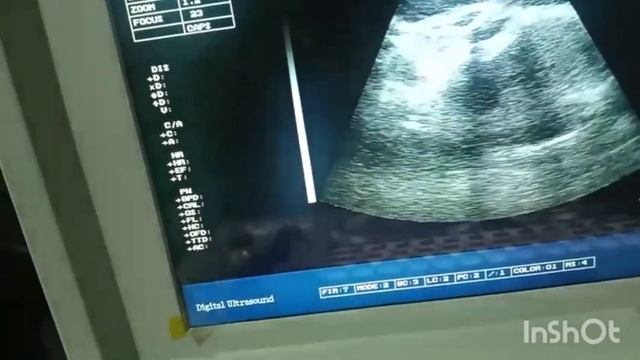 baby boy at 37 weeks on ultrasound (full term baby ) смотреть онлайн